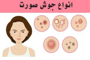 انواع بیماری پوستی جوش صورت